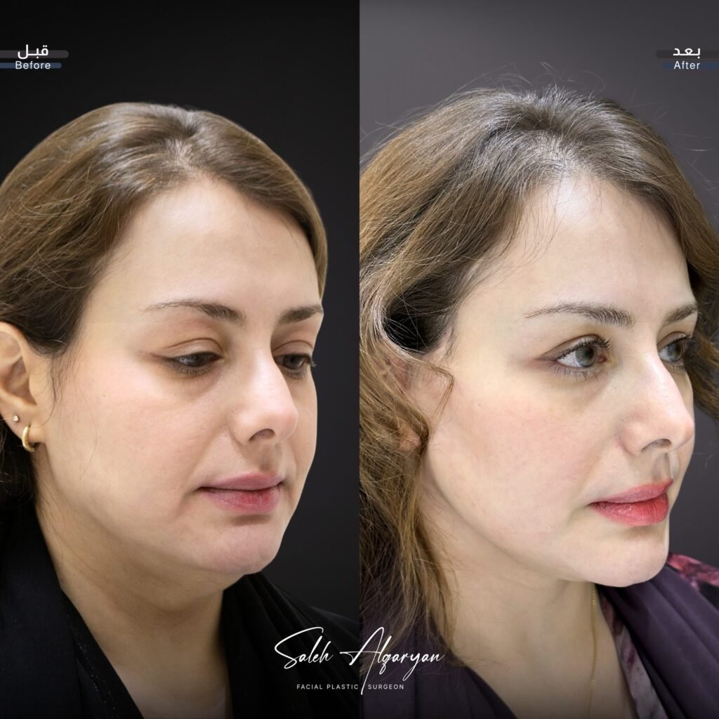 صورة قبل وبعد لشد الوجه، منظر مائل: «قبل» على اليسار و«بعد» على اليمين.