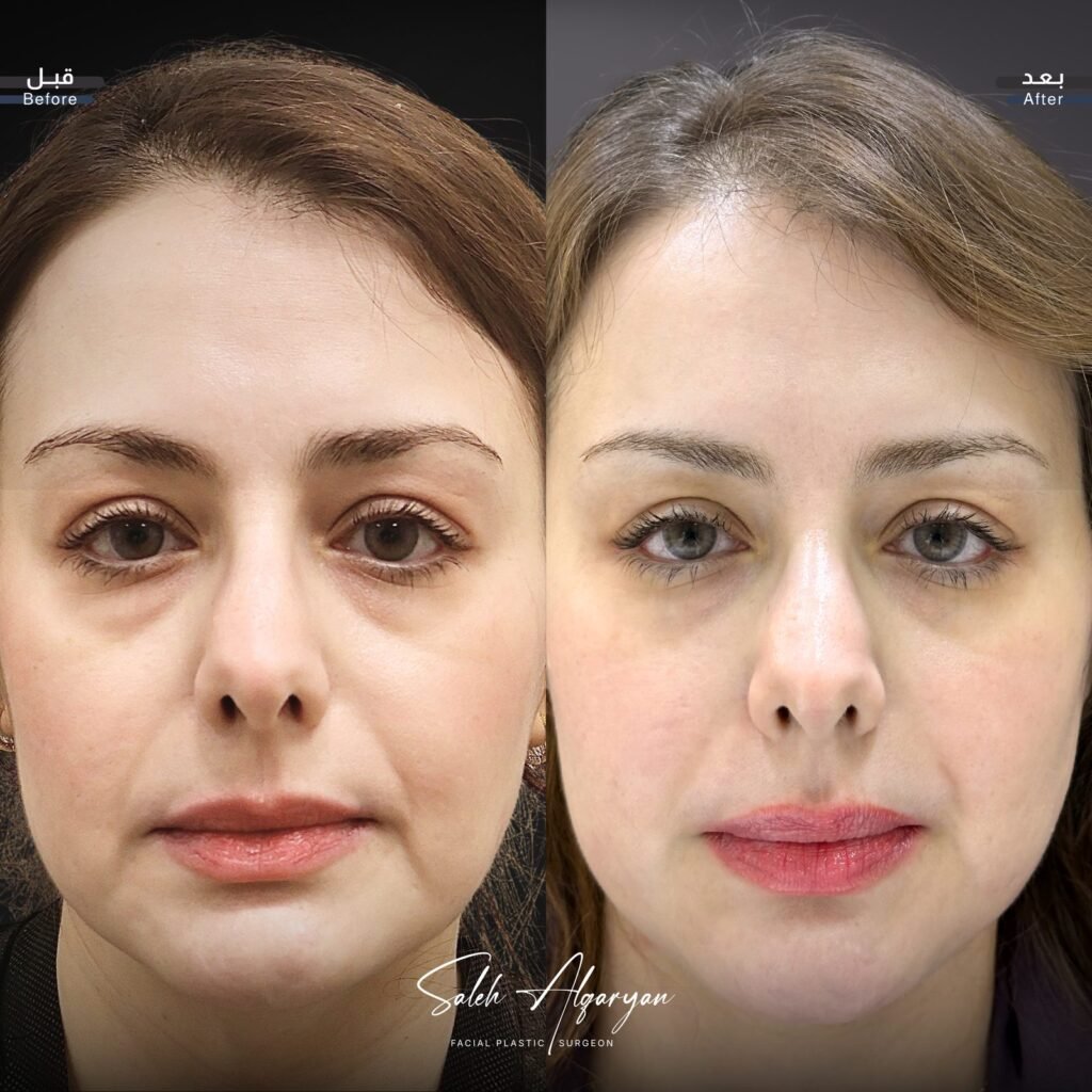 صورة قبل وبعد لشد الوجه، منظر أمامي: «قبل» على اليسار و«بعد» على اليمين.