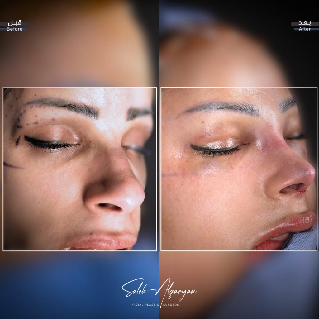 صورة قبل وبعد لتجديد شباب الوجه، منظر قريب لمنطقة العين: «قبل» على اليسار و«بعد» على اليمين.