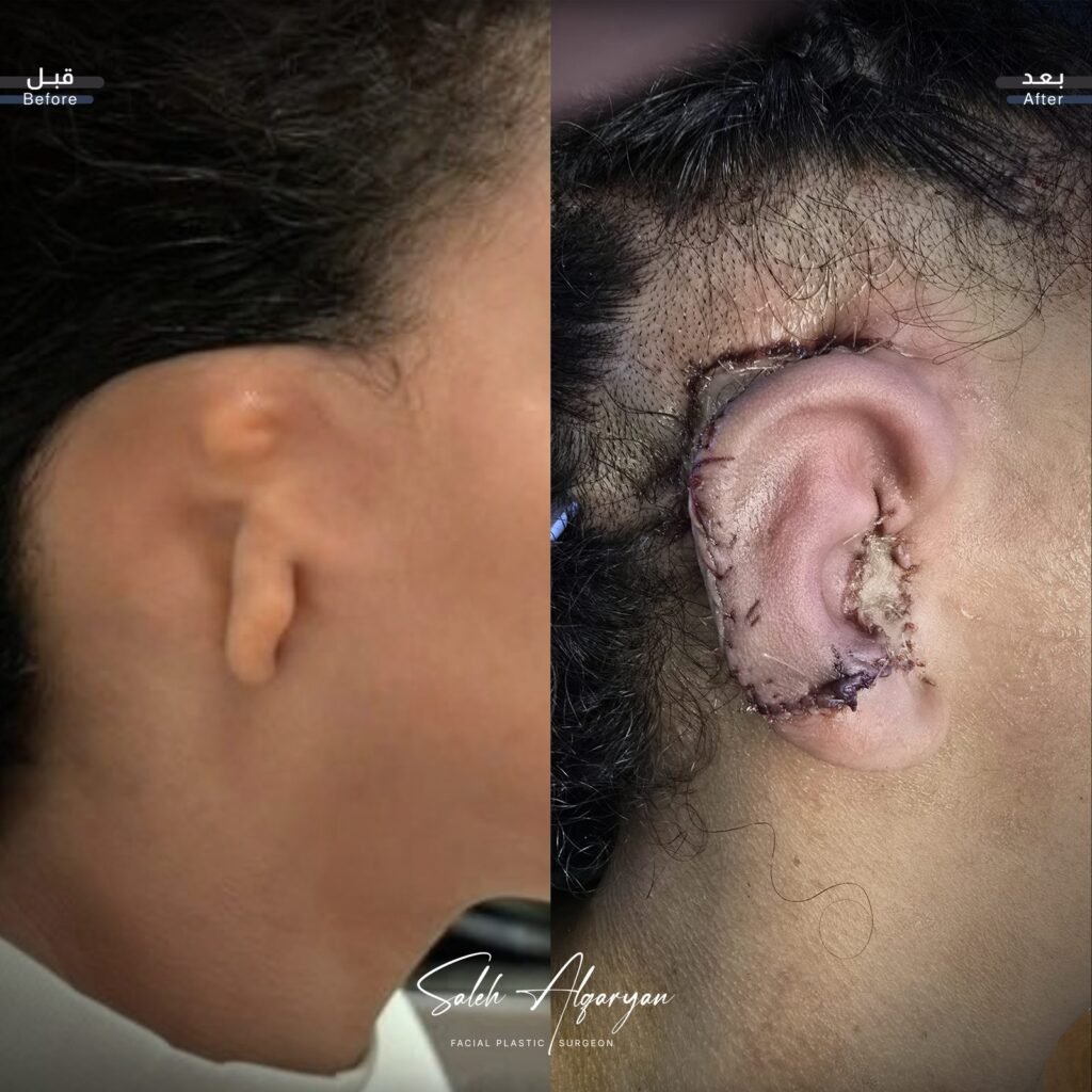 صورة قبل وبعد لترميم الأذن، منظر جانبي: «قبل» على اليسار و«بعد» على اليمين. التُقطت صورة «بعد» بعد الجراحة بفترة قصيرة.