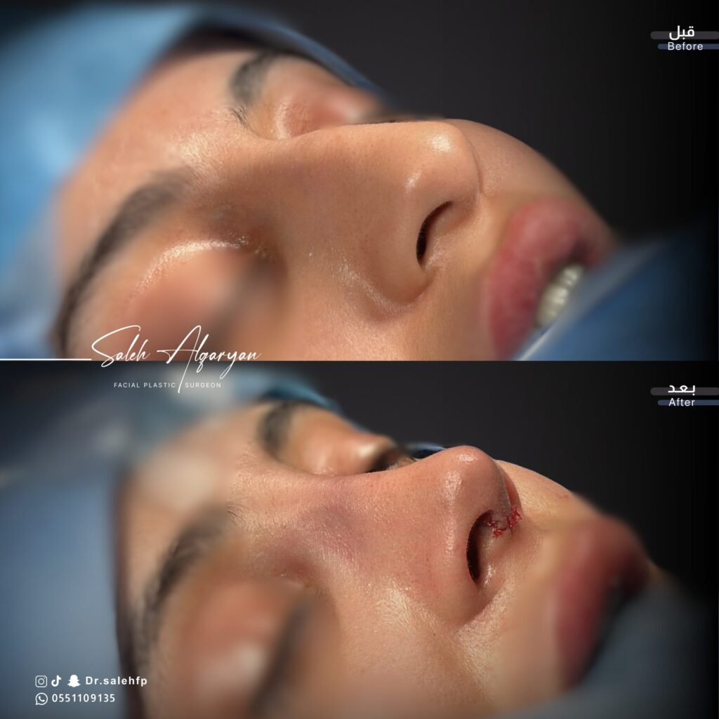 صورة قبل وبعد لتجميل الأنف، منظر للأنف من الأسفل: «قبل» في الأعلى و«بعد» في الأسفل.