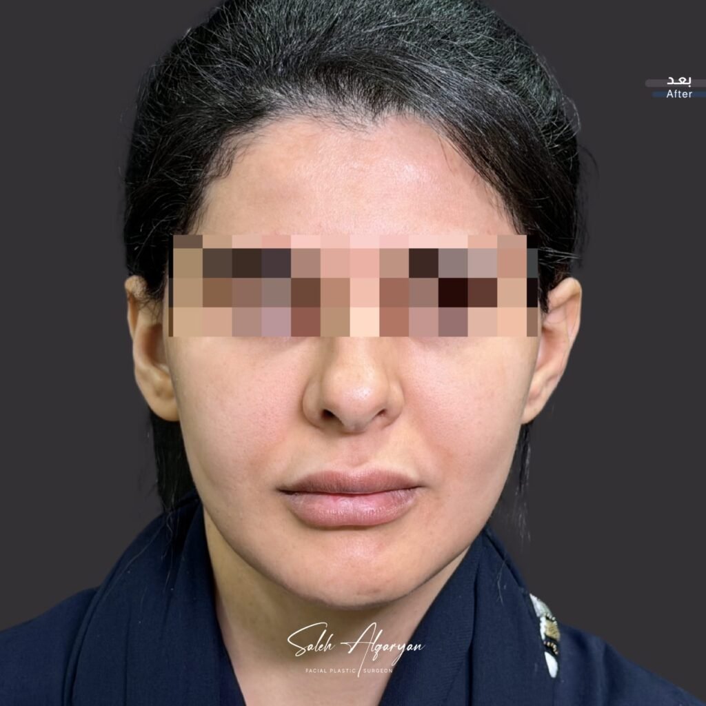 بعد الجراحة، منظر أمامي. العينان مخفيتان حفاظًا على الخصوصية.