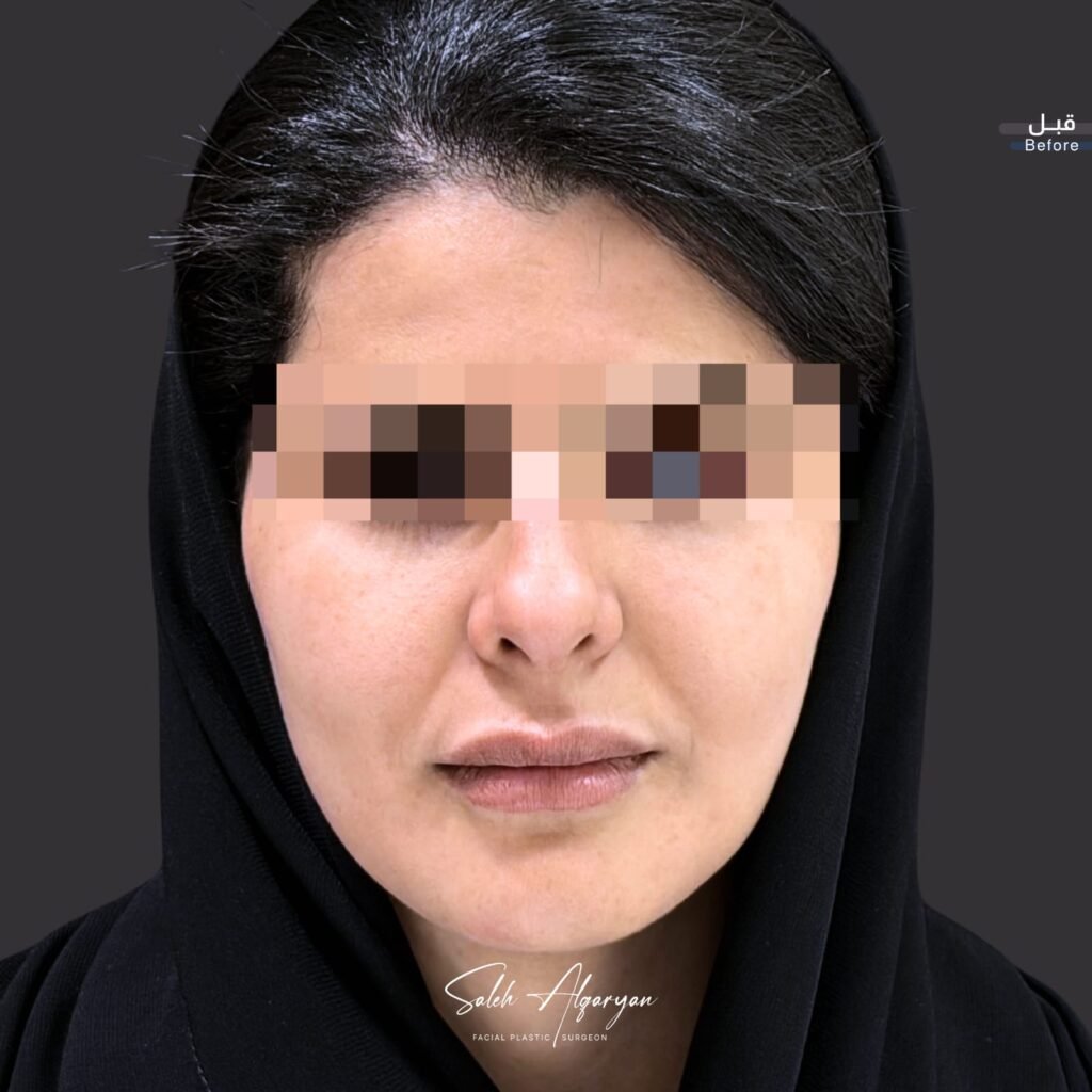 قبل الجراحة، منظر أمامي. العينان مخفيتان حفاظًا على الخصوصية.