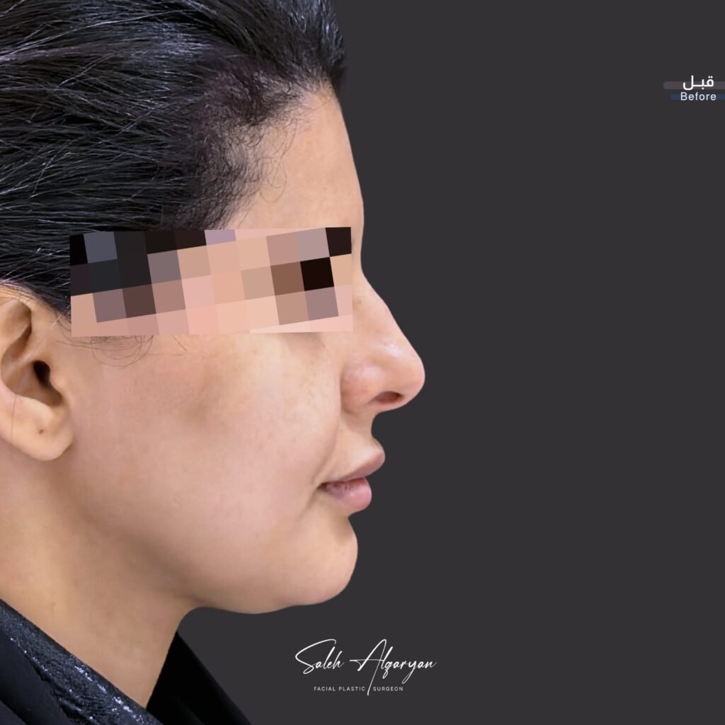 قبل الجراحة، منظر جانبي. العينان مخفيتان حفاظًا على الخصوصية.